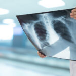 Inhaled Dry Powder Treprostinil Shows Safety and Efficacy in PH-ILD